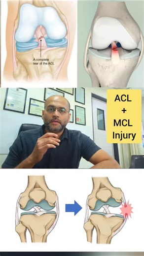 ACL with MCL injury surgery results | Multi ligament injury of knee | Dr. Prateek Joshi | Atharva Orthopaedic Super Speciality Hospital