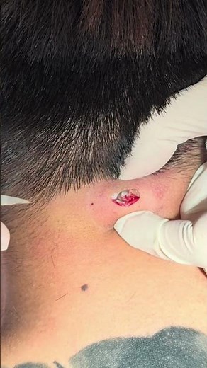粉瘤反覆發炎、腫脹或異味困擾嗎？採微創切口方式切除粉瘤囊袋