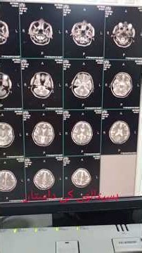 🧠 MRI Brain Scan Explained | Amazing Brain MRI Images & Complete Study | Radiology