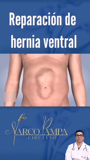 Reparación de Hernia Ventral: Procedimientos Efectivos