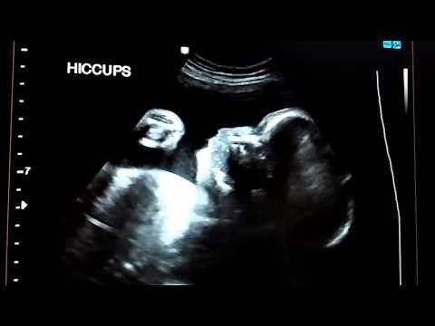 Hiccups in the womb.