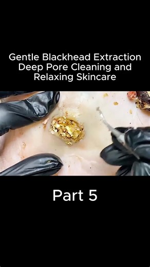 Effective Solutions for Acne and Blackhead Removal