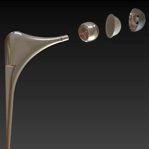 Hip Prosthesis – Georgia Tech Case Study Inspired Design