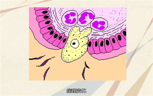 [5.4.1] 溶组织内阿米巴的致病、诊断、流行与防治