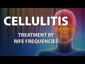 Cellulitis (Bacterial infection) - RIFE Frequencies Treatment - Energy & Quantum Medicine