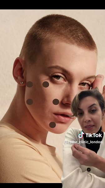 The injection technique for Profhilo is super important and can help ensure you acheive the desired result! #profhilo #skinbooster #skincaretips #mesotherapy #skintok