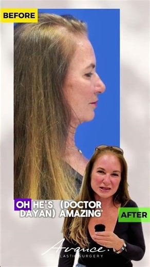 Neck Lift Patient Testimonial/Before & After | Avance Plastic Surgery Institute: Dr. Erez Dayan