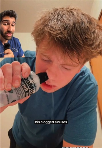 POV: Your Nose is Blocked. Sources- Personal Clinical Experience bretttuszka on TT A sinus rinse serves as a valuable complementary therapy alongside medical treatments like antibiotics by providing direct physical cleansing to the nasal passages. While antibiotics work systemically to target and kill underlying bacterial infections, they do not physically clear the stagnant mucus, inflammatory debris, and trapped allergens clogging the sinus cavities. Utilizing a saline rinse physically flushes