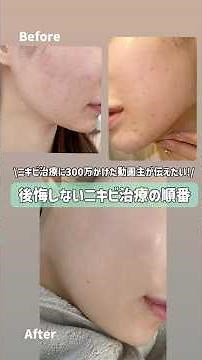ニキビ治療に300万以上かけた私が伝えたいニキビ治療の正しい順番。