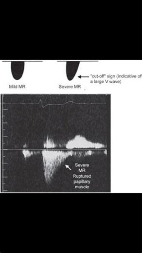 Continuous Wave (CW) Doppler MR Jet Velocity In severe MR, the continuous wave Doppler signal of the regurgitant jet is truncated, triangular, and intense. Notching of the continuous wave envelope (cut-off sign) can occur in severe MR. What it looks like on Doppler: 》Mild MR: A Parabolic shaped signal in systole, peaking mid-systole and gradually decreasing. 》Severe MR (V-wave Cutoff): The signal rises, then suddenly flattens or rapidly decelerates (cuts off) in late systole, forming a blunt or 