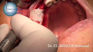 2.9K views · 47 reactions | a narrow ridge. we used ROTT expanders to place a 3.8 mm 12 mm with MPM bone graft and collagen membrane. the 12 is a ROOTT form implant so a bridge will be done between the new and the old implant | International group for Oral Rehabilitation | Facebook