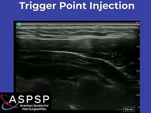 Ultrasound Guided Trigger Point Injections