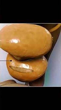 Enlarged Prostate Gland Treatment 😱 (3D Animation) #enlargedprostate #prostateproblems #prostateprob