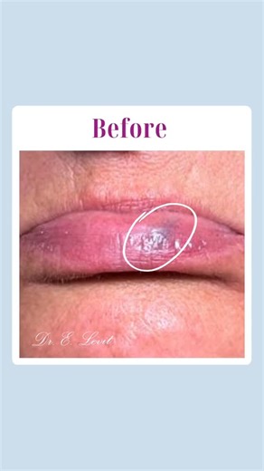 Eyal K. Levit MD, FAAD, FACMS on Instagram: "✨ Hemangioma Treatment with Derma V Laser ✨ Before ➝ After Hemangiomas are benign vascular lesions that can be safely treated with precision laser technology. This case highlights targeted treatment of a lip hemangioma using the Derma V Laser, designed to protect delicate areas while improving appearance over time. 🔴 Selectively treats vascular lesions 🎯 High precision with minimal damage to healthy tissue ✨ Progressive clearing and improved skin ap