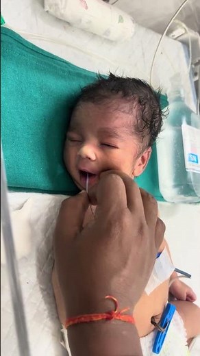 Newborn Baby NG Tube Insertion | Step-by-Step Feeding Tube Procedure for Infants