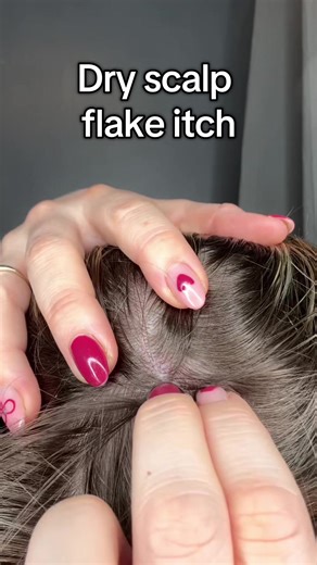 Effective Solutions for Itchy Scalp and Dandruff