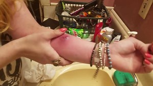 Crazy MRSA Cyst ! Most Favorite Videos: 1. A DrPimplePopper TBT: The ones that come out clean @ https://fb.com/321818478359649 2. Severe acne on the cheeks & Whitehead Removal Cyst Pimple Popping @ https://fb.com/620981811658515 3. Removal Blackheads & Whiteheads On The Face | How To Acne Treatment Easy (Part 70) @ https://fb.com/267027864217833 4. Dr Pimple Popper's Best Punch Removals of 2016 @ https://fb.com/615077828951028 5. Worst Case Removal Blackheads On The Face Easy - How To Remove Bla