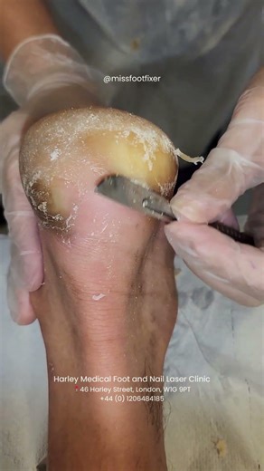 Callus Removal in Progress (So Satisfying) by Miss Foot Fixer Marion Yau