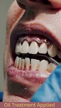 Complete Teeth Cleaning & Whitening | Full Dentist Procedure 🦷✨