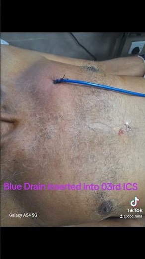 Left sided loculated Empyema Thorasis drainage | Anterior approach Tube Thoracostomy #hospital