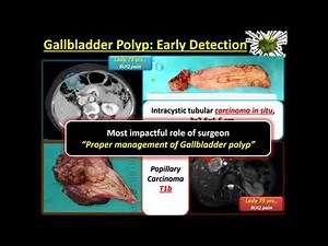 Approach to Gallbladder polyp