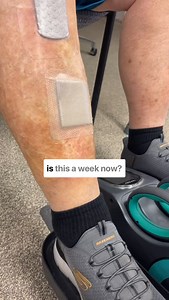 What to Expect 1 Week After Total Knee Replacement Surgery It’s been 7 days since surgery—here’s a quick look at what most patients experience: • Swelling & Bruising: Totally normal! Keep elevating and icing. • Mobility: You should be up and walking (with a walker or cane), doing light exercises 2-3x/day. • Pain: It’s still present, but manageable with meds and movement. • Sleep: Tough, especially due to leg discomfort at night. Try pillows under the calf, not the knee. Goals this week: • Bend t