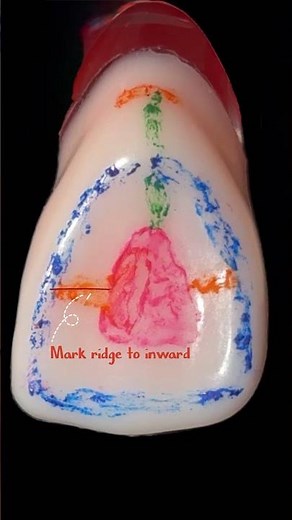Outline Form of Maxillary Central Incisor Access Preparation |Dr.Dentique-hub