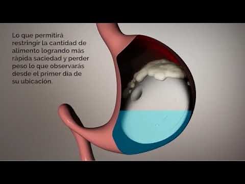 Nuevo balón gástrico Elipse: biodegradable, sin endoscopia y sin anestesia.