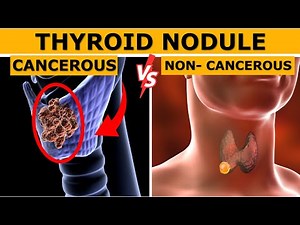 Cancerous vs Non cancerous Thyroid Nodules : How to Tell the Difference? | Dr. Gaurav Gangwani