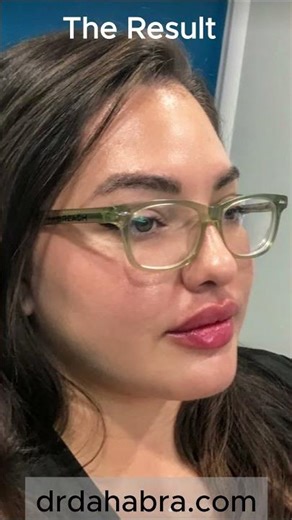 Lip Filler vs. Lip Flip: Dr. Dahabra’s Stunning Before & After Results! #shorts