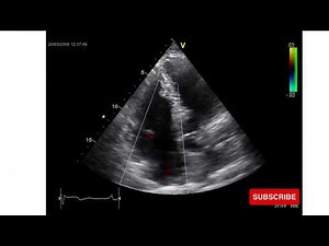 Ebstein Anomaly | Congenital Heart Disease | Echo