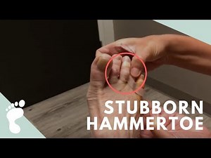Stubborn Hammertoe & Follow Up