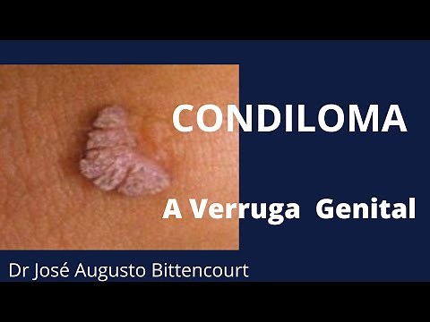 CONDILOMA (VERRUGAS GENITAIS)