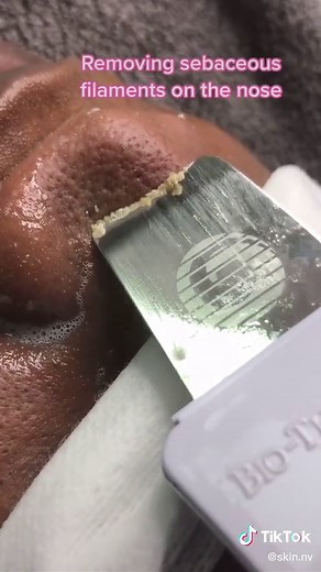 Removing Sebaceous Filaments on the Nose - Facial Skincare Routine