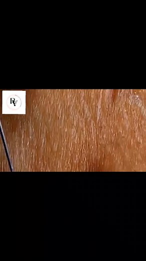 relaxingpimplevideos on TikTok