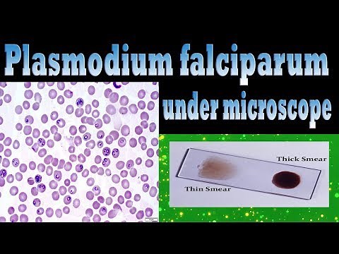 plasmodium falciparum under microscope - Trophozoites,Schizont,Gametocytes(clear explain)