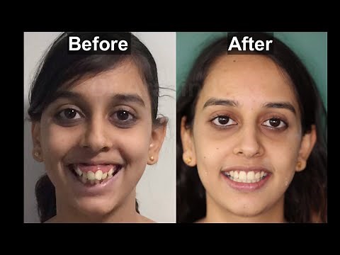 BRACES | before and after | BEST SMILE TRANSFORMATION | Gummy smile | smile design | call 9676145271