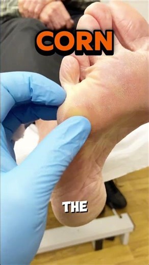 When you see a painful corn under the little toe joint (the 5th metatarsal head), it’s usually not