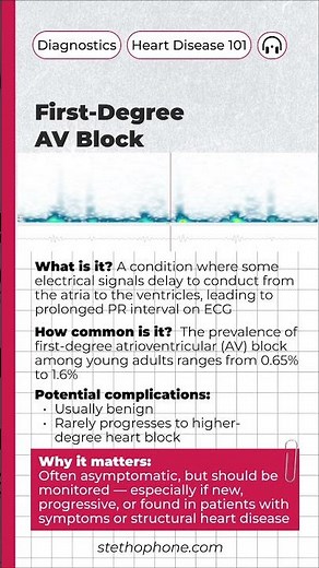 Heart Rhythm Abnormality 101: First Degree AV Block