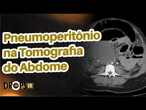 RECONHECENDO O PNEUMOPERITÔNIO NA TOMOGRAFIA DO ABDOME I VOCÊ RADIOLOGISTA