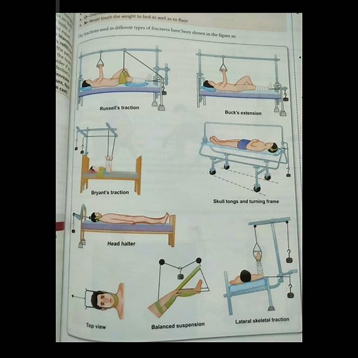 Different types of traction...