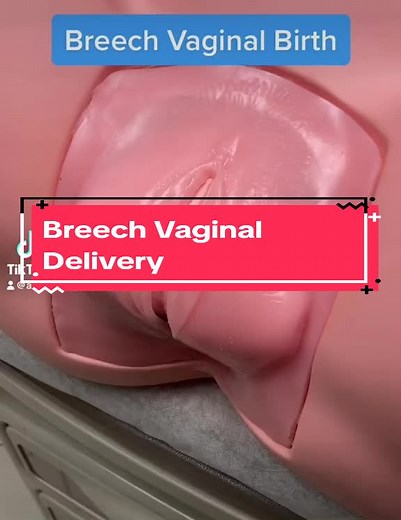 Breech Vaginal Delivery Process Explained
