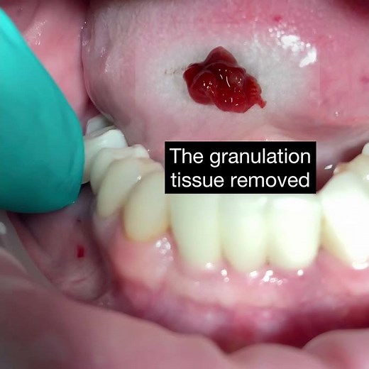 Serrated Curette helps Remove Granulation Tissue from Dental Infections
