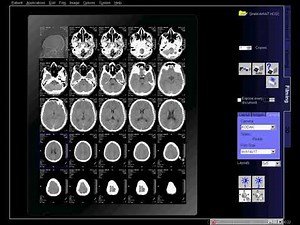 CT Scan of Brain fliming''SIEMENS''