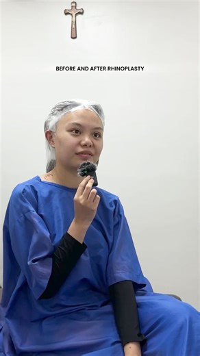 Here’s why Ruby Shai chose Dr. Ruth to do her nose job. ✨👃🏻🧚🏻‍♀️ Visit us! 👇🏻 👩🏻‍⚕️ RPS Aesthetics ☎️ 0930 896 9228/ (02) 7001 3150 📍 J & S Building, 104 Kalayaan Avenue, Diliman, Quezon City Other clinic locations: 📍 Cinco Marias Aesthetic Clinic and Wellness Spa, Batangas 📍 Drents Multispecialty and Aesthetic Clinic, Pampanga #rhinoplastyphilippines #rpsaesthetics #rhinoplastyfairy #drruthlyn #drruthlynpecolerasalvosa #rhinoplastytips #RPSRubies #RPSRuby #RPSBaby Rhinoplasty Rhinopl