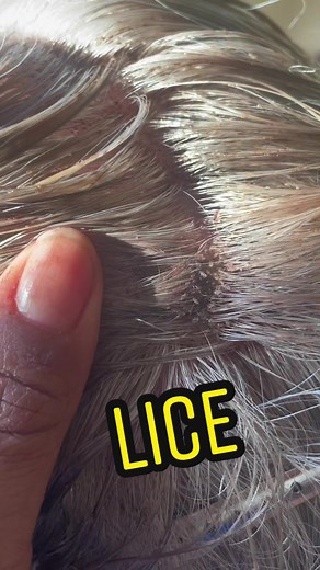 Head lice up close #explore #lice #foryou #liceremoval #liceinfestation #licetok #hair #fyp