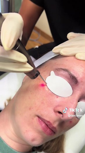 Melasma can be tough, but you don’t have to deal with it alone. Our Hollywood Spectra laser safely targets excess pigmentation breaking it down without harming your skin. With a series of treatments, you’ll see a brighter, more even complexion. Stay tuned for her results! #phoenix #fy #fypp #arizona #skincare #skin #medspalife #booknow #foryoupagе #fypシ #chandler #lutronic #foryoupageofficiall #esthetician #melasma #melasmatreatment #pigmentation #pigment #laser #lasertreatments #staytuned