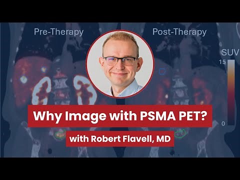 Visualizing Prostate Cancer: Why Image with PSMA PET?