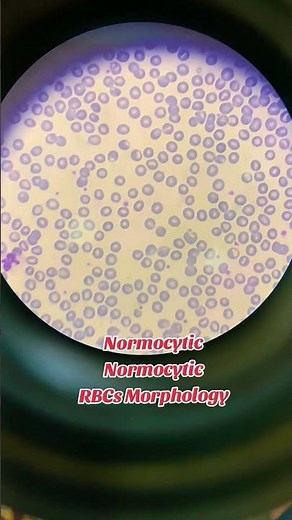Normocytic Normochromic Red cells Morphology.