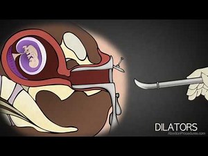 1st Trimester Abortion